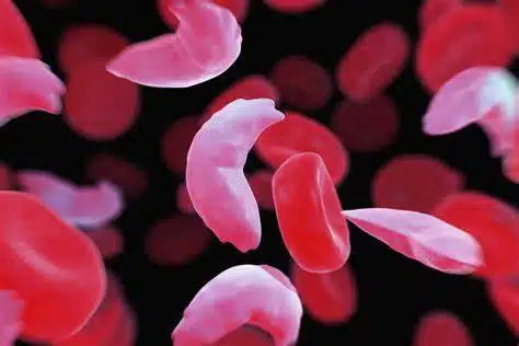 Sickle Cell Anemia