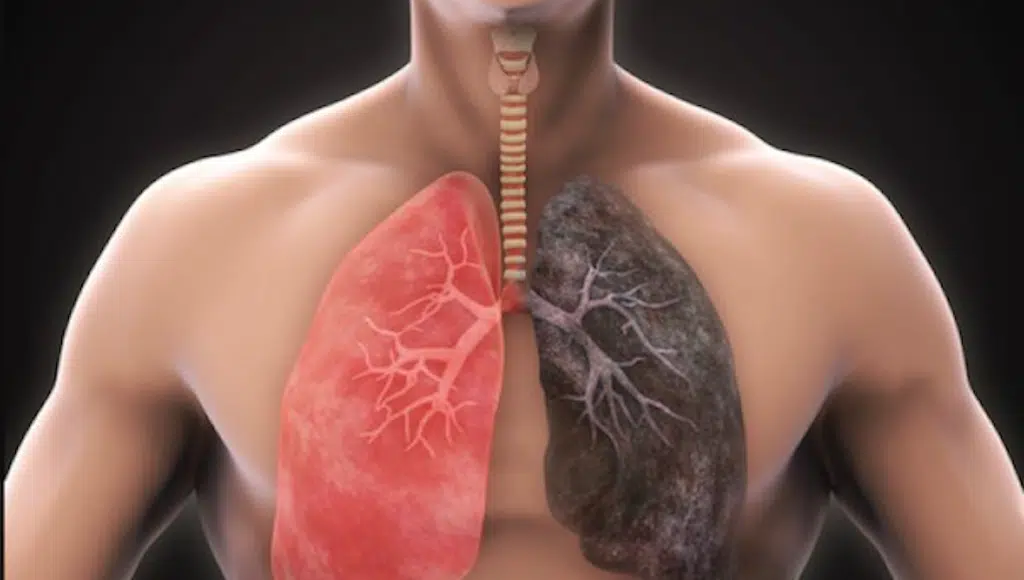 Lung Disease