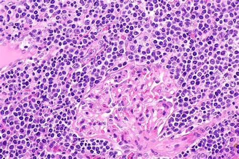 lymphoma
